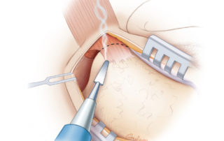 The insertion of the sternocleidomastoid muscle is dissected off the mastoid tip with electrocautery.