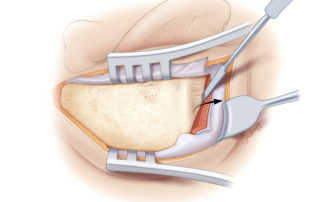 The temporalis muscle is elevated from the linea temporalis. Note that a small relaxing incision is often made posteriorly.