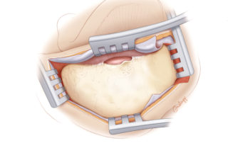 Completed exposure for mastoidectomy. Two retractors are set, one spanning from the ear canal to the sinodural angle. Care must be taken when opening this retractor lest the meatal skin be torn. Liberating the meatal skin from the osseous meatus reduces this likelihood. The second retractor elevates the temporalis muscle and depresses the sternocleidomastoid muscle.