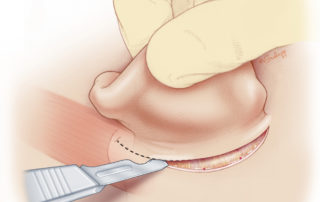 Incision is carried through the dermis with a scalpel. Some surgeons open the skin with electrocautery.