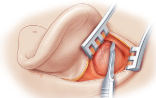 During dissection above the ear, a hood commonly develops, which should be sharply parted.