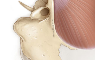 The temporalis muscle lives in a fossa whose lower edge is the linea temporalis: an important landmark in opening the ear from behind.