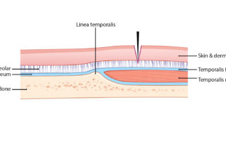 Soft-tissue layers illustrated in relation to the linea temporalis.