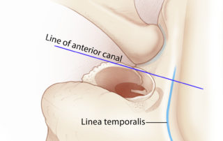 The incision of periosteum along the linea temporalis should be carried forward to the level of the anterior aspect of the ear canal so that the soft tissues rotate forward to enable a full view down the ear canal to the middle ear structures.