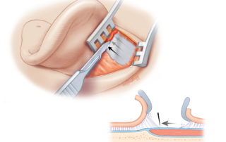 Sweeping with a scalpel while clicking open the mastoid retractor to maintain tension in the soft tissues expedites identification of the temporalis fascia. Note that the scalpel blade is tilted superiorly. If directed inferiorly, it tends to cut into the fascia and can even open the roof of the external auditory canal.