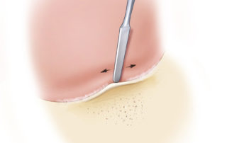 Commencing elevation of the ear canal flap (skin and periosteum) from Henle’s spine. Note the cribriform region just posterior to the spine.