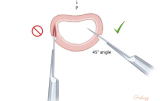 In making the vertical limbs, it is important to angle the cut by 45 degrees lest the incision simply penetrates the soft tissue of the canal and not properly enter the lumen.