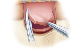 The incisions can be carried laterally using either scalpel or scissors.