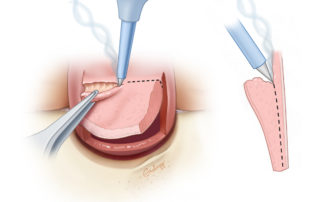 Thinning the flap is an important part of soft tissue canaloplasty.