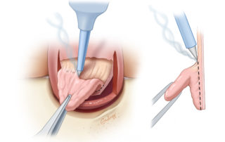 To minimize bleeding, electrocautery may be helpful in thinning the flap.