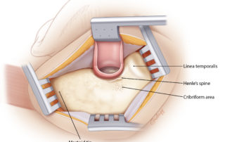 View of the mastoid and ear canal after completion of the posterior ear canal flap.