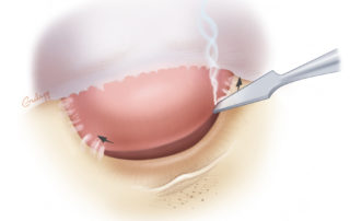 When the flap adheres to the tympanomastoid (inferior) and tympanosquamous (superior) suture lines, a needle point electrocautery may be used to effect sharp elevation.