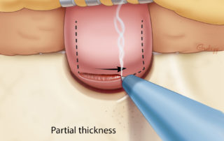 One option for incising the ear canal skin is a posterior ear canal flap (also known as a Koerner’s flap). Because ear canal incisions can bleed significantly, the periosteum and dermis is parted with needle point electrocautery.