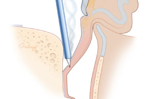 The incision is initiated part way down the osseous canal.