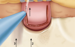 Cutting the vertical limbs of the flap. These are done from medial to lateral so that any bleeding will not obscure continuation of the incision.