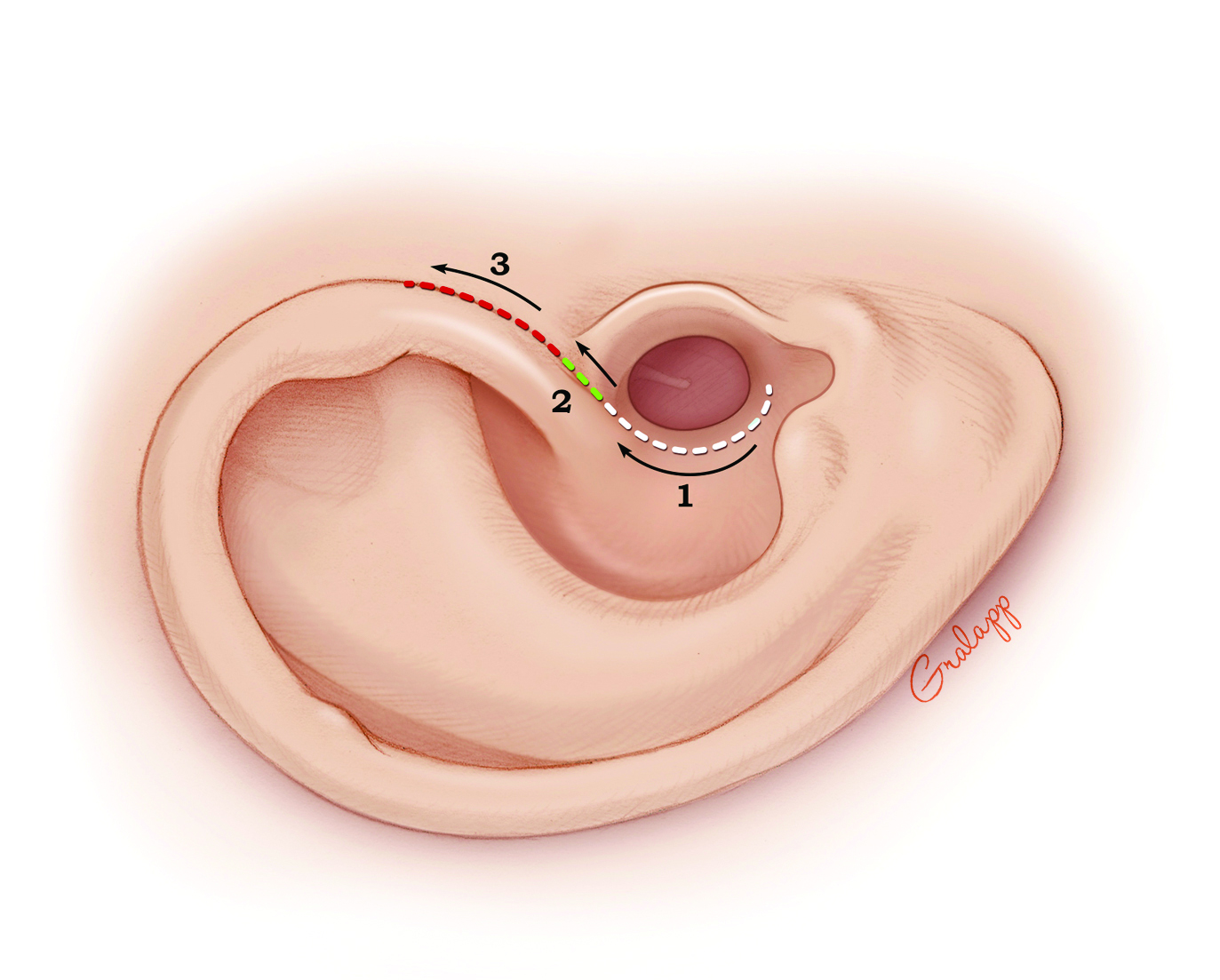There are three segments to an endaural incision: circumferential, intercartilaginous (between the helical crus and the tragus), and the vertical limb. It is less commonly used today compared to the postauricular incision due to the visibility of the scar and limitation of exposure posteriorly.