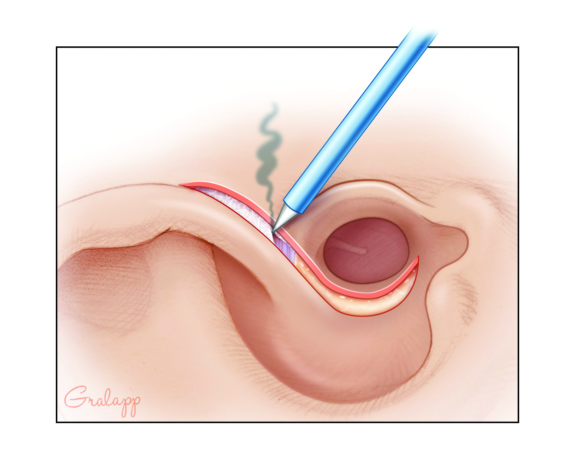 Needle point electrocautery through the dermis to the temporalis fascia superiorly.