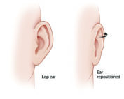 In closing a postauricular incision following tympanomastoid procedures, the pinna may rotate outward and develop a cosmetically undesirable prominence (i.e., lop ear). This is especially the case in children due to the flexibility of their cartilage.