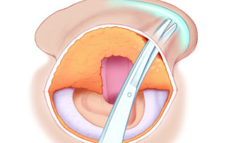 Placement of an anti-lopping suture begins with tunneling to expose antihelical fold.