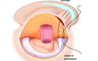 Placement of an anti-lopping suture. To avoid the suture pulling through the perichondrium while tying, the ear is pushed from its ventral side against the head.