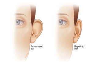 A prominent ear can be caused by lack of an antihelical fold or prominence of the conchal cartilage, or both. Otoplasty can be used to correct both of these, resulting in a less prominent pinna on frontal view.