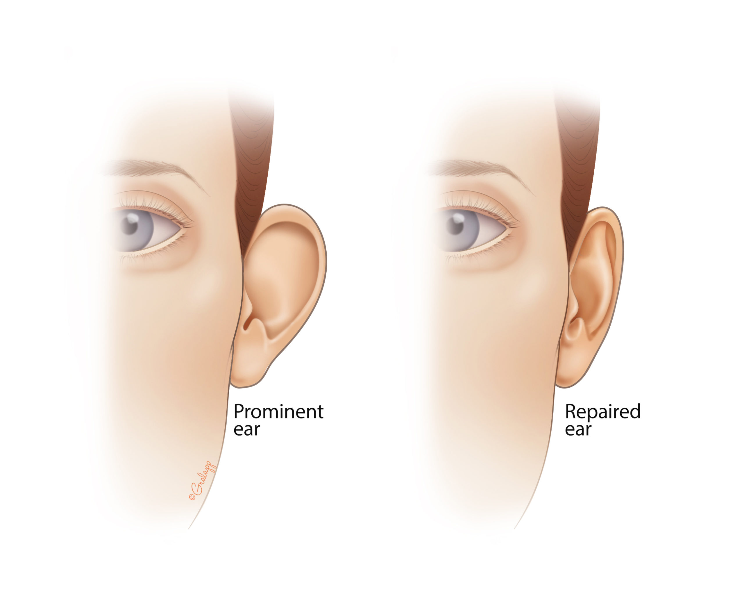 Prominent shop ear correction