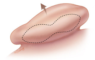 The posterior skin excision is done in elliptical fashion. This helps reduce posterior tethering in the midportion of the pinna, which can contribute to a “telephone ear” deformity.