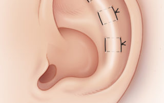 The ear is reflected anteriorly, and the black sutures visualized. Clear nylon mattress sutures are then placed according to the method of Mustardé. Care is taken to avoid violation of the anterior auricular skin.