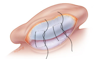 Transcutaneous black nylon sutures are placed to create the superior antihelical fold. These are typically 5-mm wide and separated by 1 cm. The width and tension of the mattress sutures will cause variation in acuity of the antihelical fold.