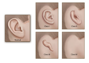The classes of microtia according to pinna size and subunits affected. For the purpose of this classification, the subunits of the pinna are helix, antihelix, scapha, tragus, antitragus, concha, and lobule. Class 1: a small ear with all of the subunits present, although some may be abnormally shaped; Class 2: a small ear with missing subunits; Class 3: a classic peanut ear with no recognizable subunits except for the lobule; Class 4: anotia (the complete absence of a pinna). Microtia surgery involves multiple stages. Some surgeons employ two stages, others employ three or more. Stages are usually spaced by 3 to 4 months at a minimum. In this chapter, we illustrate a two-staged technique as described by Dr. Francoise Firmin. Foundations from Dr. Burt Brent's four-staged technique and Dr. Satoru Nagata's two-staged technique can be appreciated.
