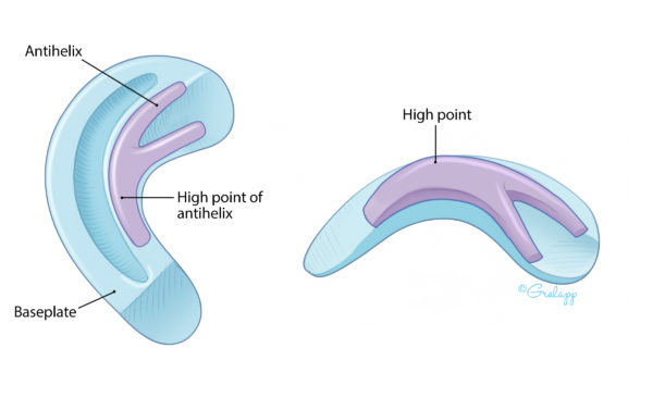 Microtia Repair: The Firmin 2 Stage Technique – Oto Surgery Atlas