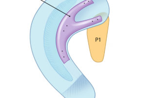 Once the antihelix is placed, the P1 piece is secured to the baseplate in preparation for the helix. The P1 piece allows for the crus of the helix to drop to a lower plane while providing stabilization to the curve of the helix.