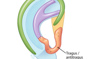 The tragus–antitragus complex is placed and secured to the baseplate and the P1 elevation piece.