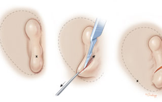 Preparation of the skin for a type 2 skin approach as described by Dr. Firmin. This approach is often chosen for class 3 microtia when the inferior portion of the microtia remnant will be used to make the lobule of the new pinna. With the planned outline for the ear reconstruction drawn relative to the microtia ear, the ear is pulled until a natural point is found where the lobule meets the planned incision with the least amount of tension on the remnant. This is where the lobule will be transposed. The X marks the point where the lobular skin meets the planned point of transposition.