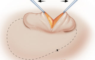 The skin is then divided and a pocket is dissected in the lobule to allow insertion of the cartilage framework. Best results are obtained when the cartilage inserts well into the lobule, near the tip.