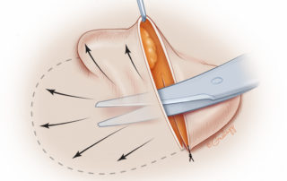 The retroauricular skin is then dissected, and the cartilage remnant is removed from the microtia ear. This skin will drape over the cartilage construct, so care must be used to maintain the skin vascularity and the same thickness throughout.