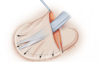 Skin dissection must go beyond the planed placement of the ear to allow for the skin to drape over the contours of the construct, and allow for placement of a posterior drain.