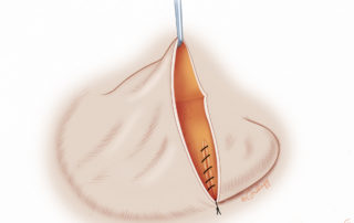 The transposed lobule is then sutured in place posteriorly, known as the “adhesion of the lobule,” with a 4-0 absorbable suture.