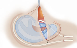 The cartilage construct is inserted into the lobule and placed under the skin. Drains are placed anteriorly and posteriorly to allow suction of the skin to aid resection of excess skin. Typically, 10F Blake drains are used, under low suction, classically maintaining suction with test tubes.