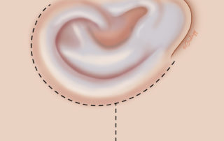 Stage 2: elevation of the ear. The initial step of stage 2 involves planning the retroauricular incision. Care must be taken to be off the edge of the cartilage framework. A releasing incision is designed to allow advancement of the retroauricular skin.