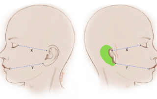 The distances from the lateral canthus of the eye to the root of the helix (X), and the lateral commissure of the mouth and the anterior point of the lobule (Y), are measured on the unaffected side. These measurements are used for placement of the reconstructed ear. The superficial temporal artery is identified with Doppler and marked.