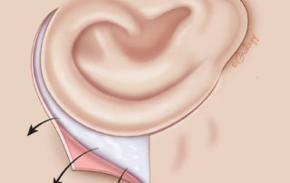 Elevation of the superior flap. It is essential to elevate only skin and leave the fascia and periosteum overlying the cortex intact.