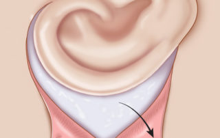 Elevation of the inferior flap. At this step, the areolar tissue overlying the mastoid can be thinned to deepen the sulcus.