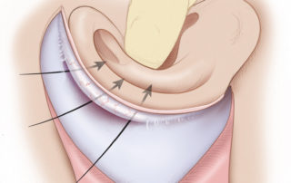 In preparation for creation of a postauricular sulcus, the auricular construct is elevated. It is essential not to interrupt the enveloping tissue surrounding the cartilage. Any exposure of cartilage will likely lead to wound dehiscence, as the skin graft will not integrate with the cartilage.