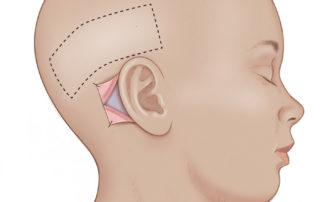 A thin split-thickness skin graft (STSG) is harvested from the hair-bearing scalp as this yields the best texture and color match for the ear. In addition, the donor site will be hidden by hair growth. The typical graft measurement is 5 × 10 cm. Some surgeons harvest skin grafts from the abdomen, groin, arm, or thigh. The graft must be cleaned of hair with gentle wipes from a wet gauze.