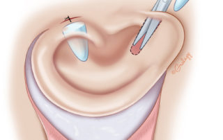 Projection of the ear is achieved through cartilage placed in tunnels, a Type D elevation technique as described by Dr. Firmin. Additionally, cartilage can be tunneled under the antihelix to deepen the conchal bowl (not shown here). This cartilage was banked in a subcutaneous pocket of the chest site during stage 1 and reopened in stage 2.