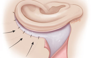 To position the incision behind the pinna and to reduce the size of the skin graft needed, the retroauricular skin flap is advanced and tacked down to the mastoid fascia using 4–0 absorbable suture.
