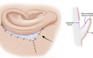The inferior flap is similarly advanced and the resulting overlap of the skin flaps is resected and sutured closed. An axial view shows the newly created posterior auricular sulcus which must be covered with the skin graft.