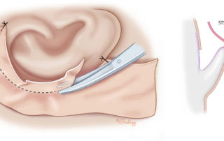 The skin graft is tacked at the superior and inferior aspects of the ear and the anterior rim of the graft is trimmed to give a fresh margin conforming to the shape of the incision. An axial view illustrates how this first skin graft is used to drape the posterior surface of the ear to the sulcus.