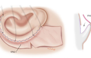 The skin graft is sewn to the anterior margin leaving some of the suture tails long to anchor a bolster once the skin graft is in place. When draping the skin graft toward the postauricular sulcus, it is sometimes necessary to trim a wedge to achieve optimal contour as the skin drapes behind the ear.